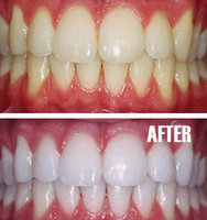 Teeth Whitening - Before & After