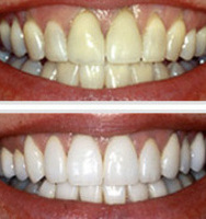 Teeth Whitening - Before & After